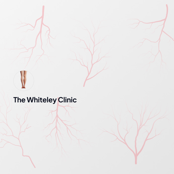 When should I have my varicose veins treated?