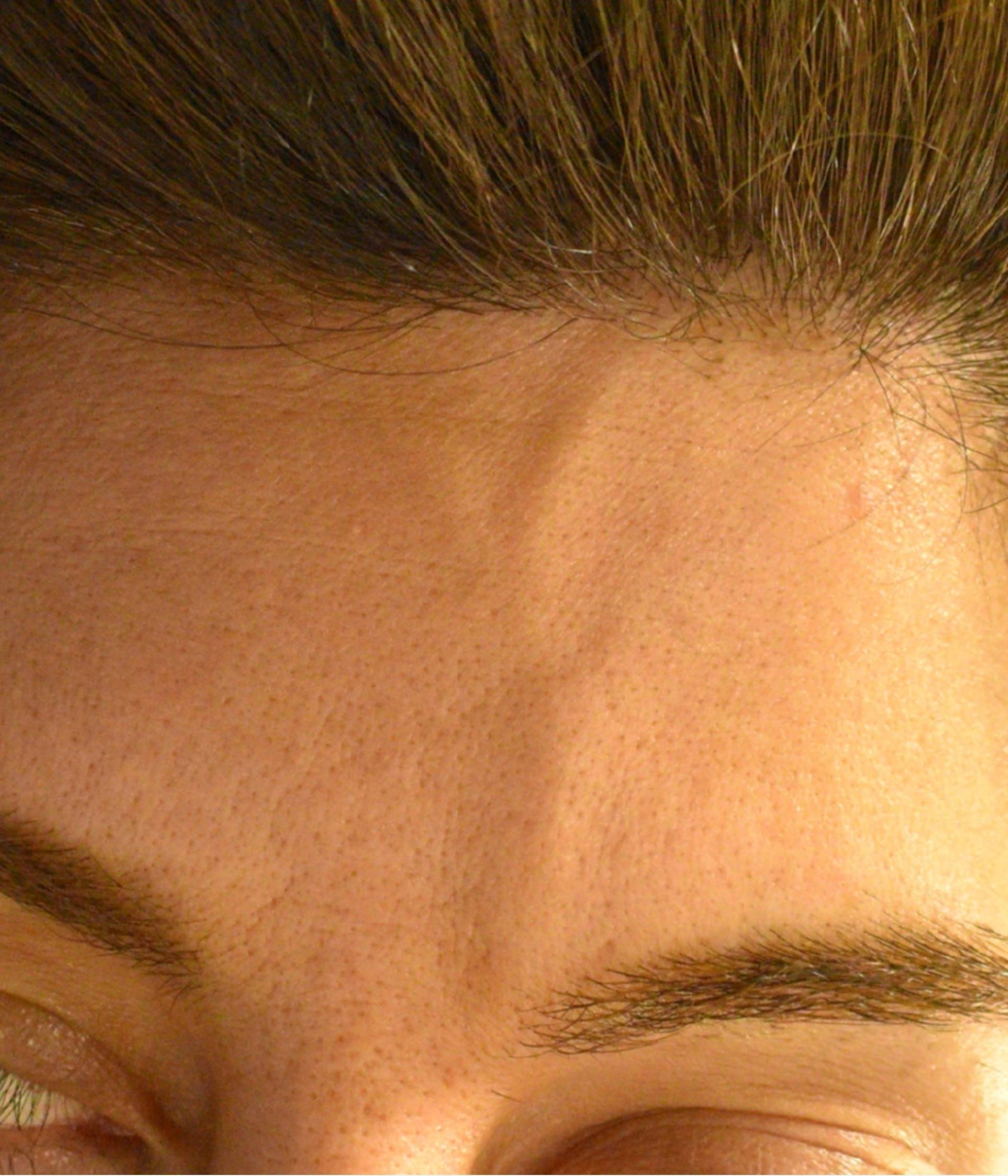 Forehead Veins