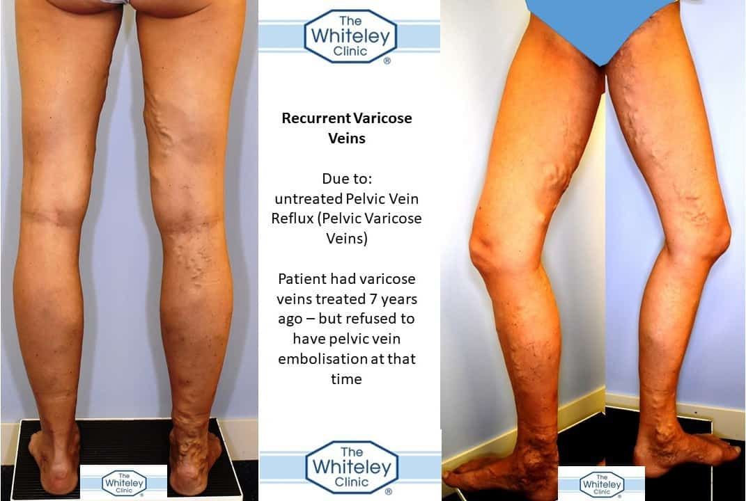 Recurrent varicose veins due to untreated pelvic veins