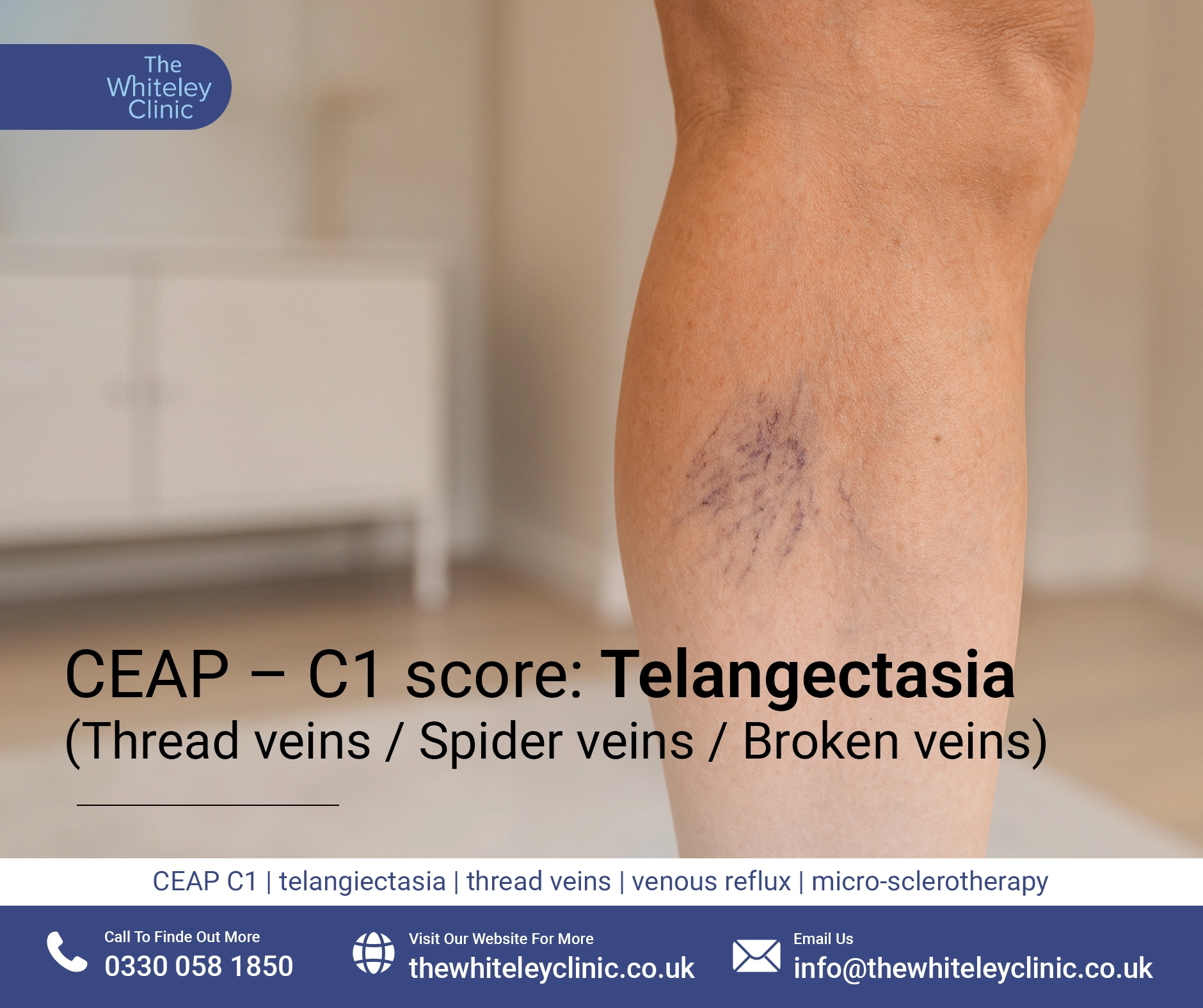 CEAP – C1 Telangectasia (Thread veins / Spider veins / Broken veins)