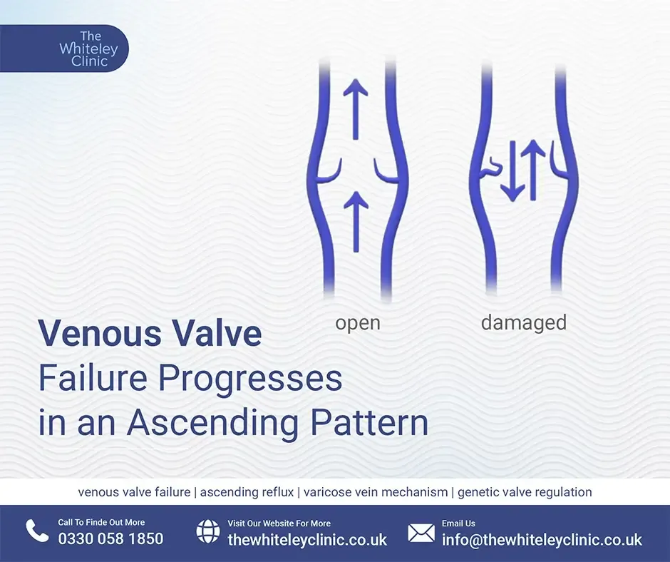 Venous Valve Failure Progresses in an Ascending Pattern