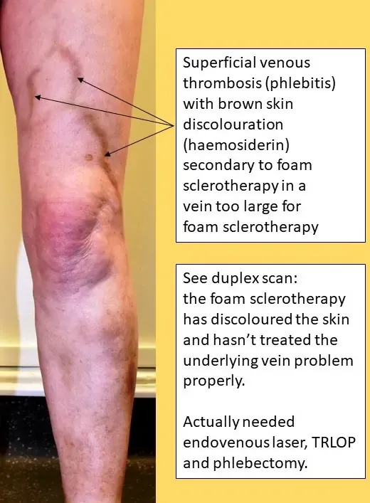 Cheap varicose veins treatment - Beware