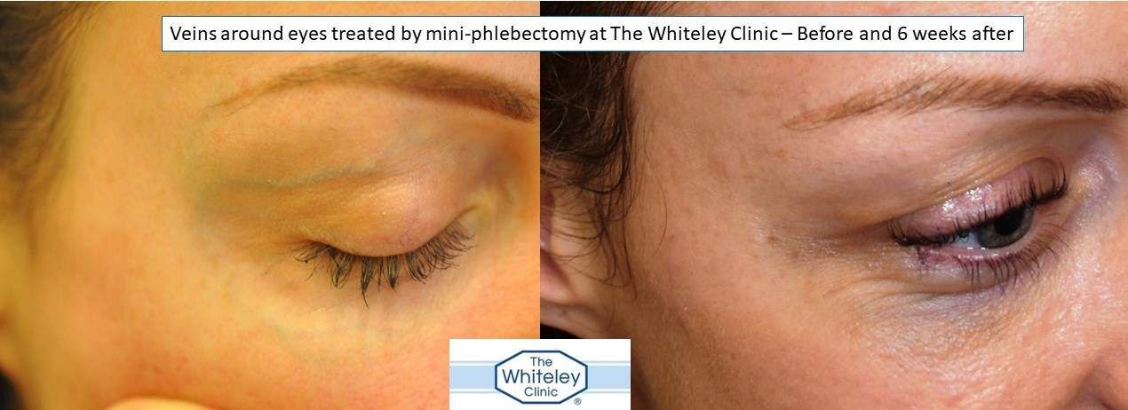 Veins around eyes removed by mini-phlebectomy