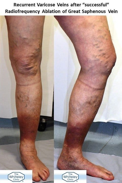 Recurrent varicose veins after "successful" RFA
