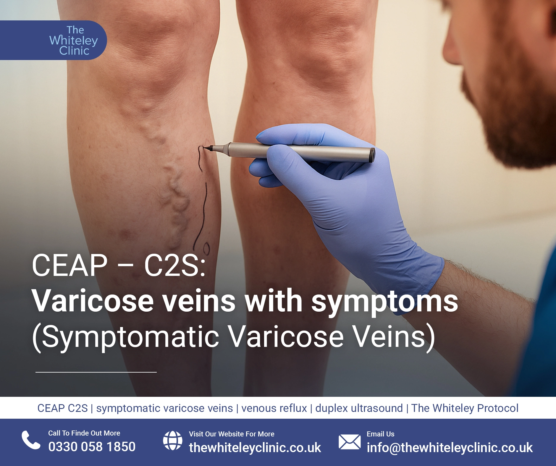 CEAP – C2S: Varicose veins with symptoms