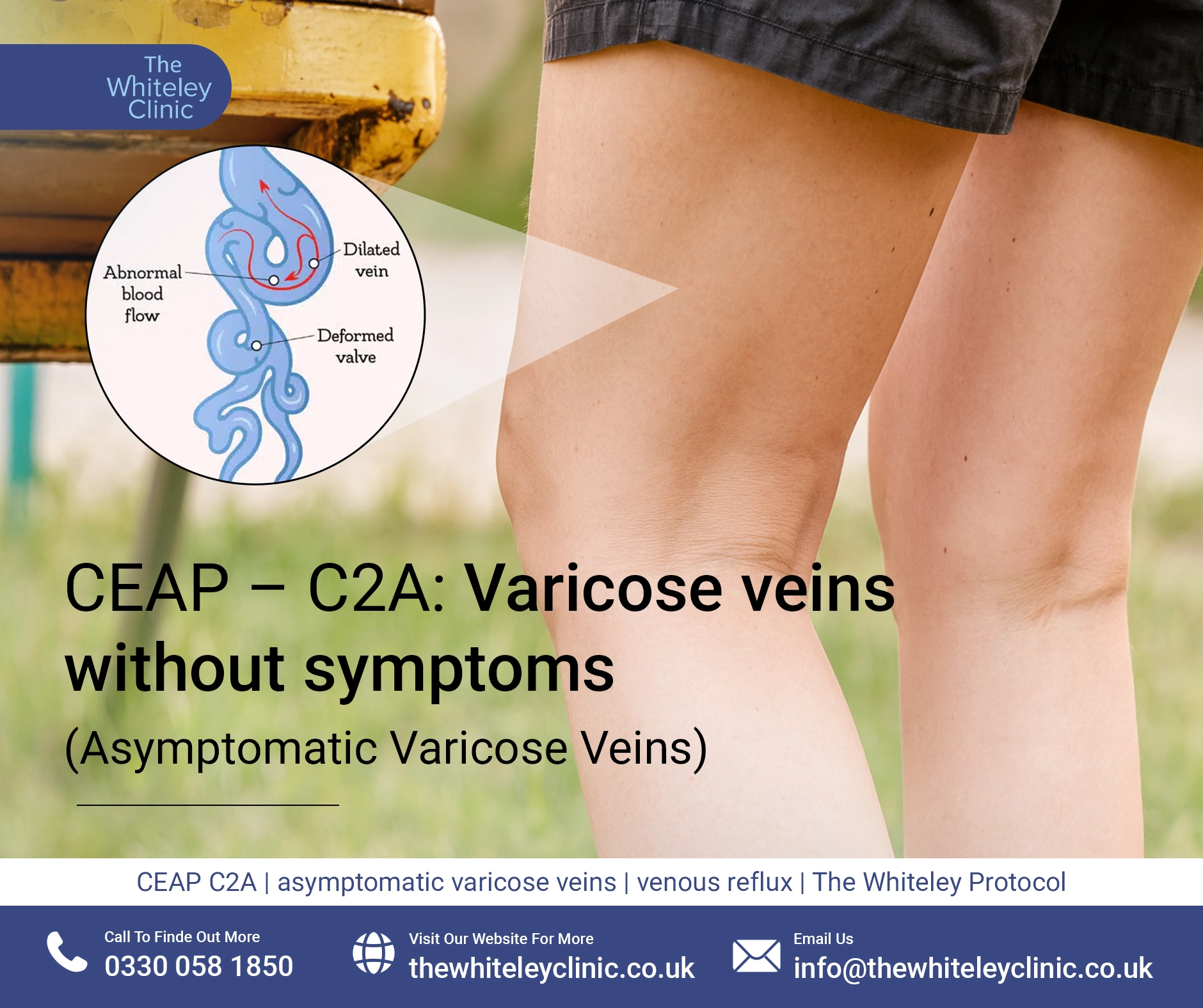 CEAP – C2A: Varicose veins without symptoms (Asymptomatic Varicose Veins)