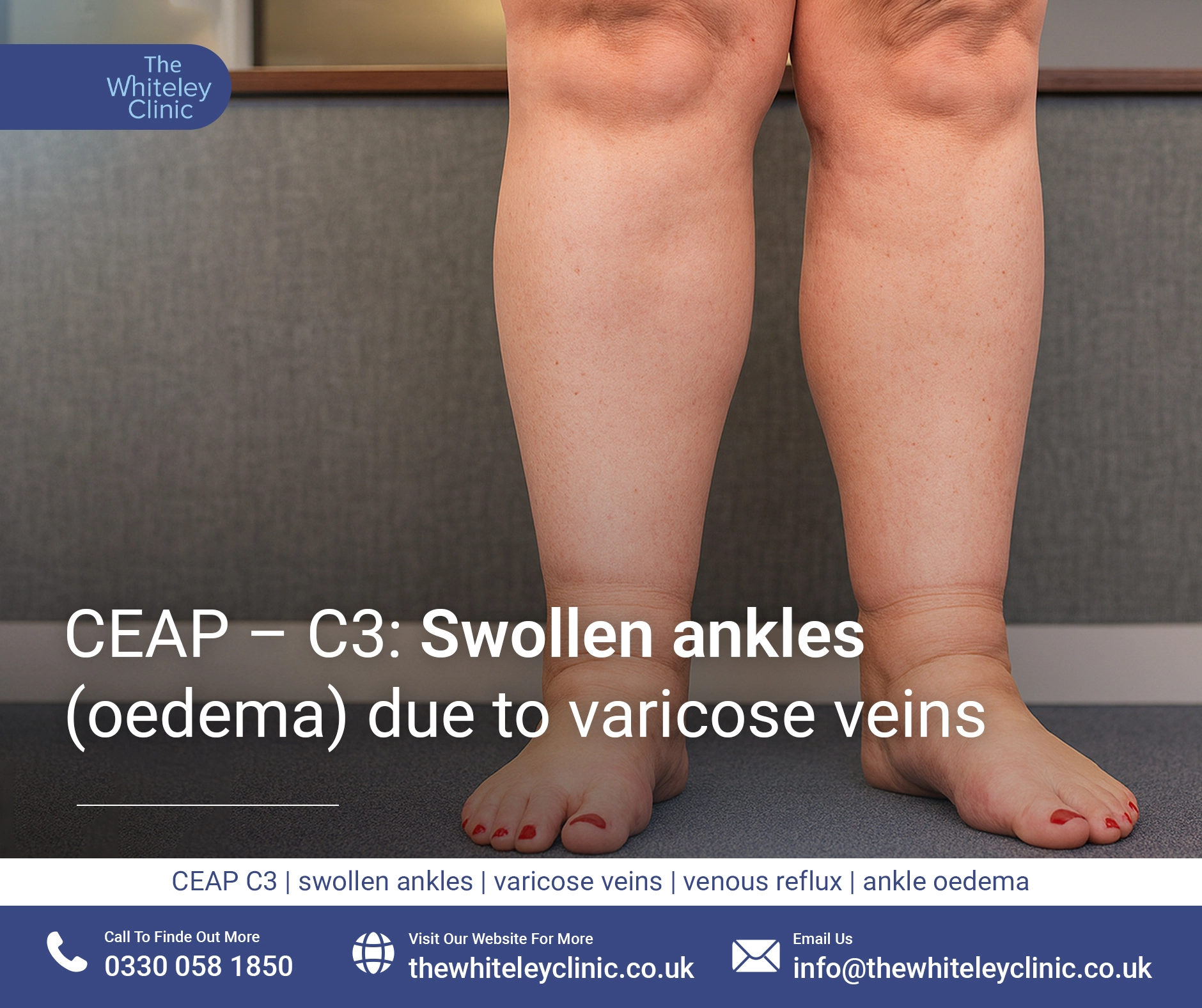 CEAP – C3: Swollen ankles due to varicose veins
